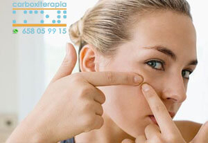 Tratamientos Esteticos Carboxiterapia Acne Tratamiento en MADRID